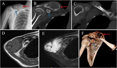 Case report: Intraosseous hemangioma of the lateral clavicle treated by surgical resection and reconstructed by three-dimensional-printed personalized prosthesis